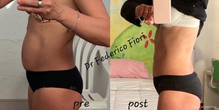 Diastasi dei retti — Prima e dopo