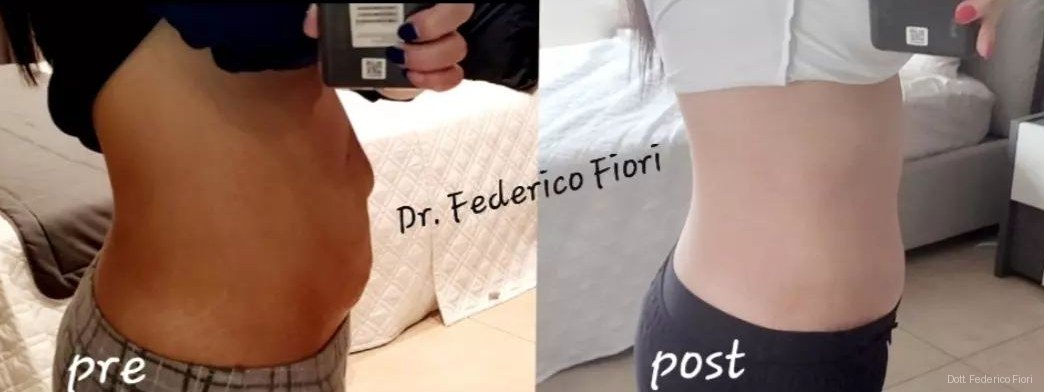Diastasi dei retti — Prima e dopo