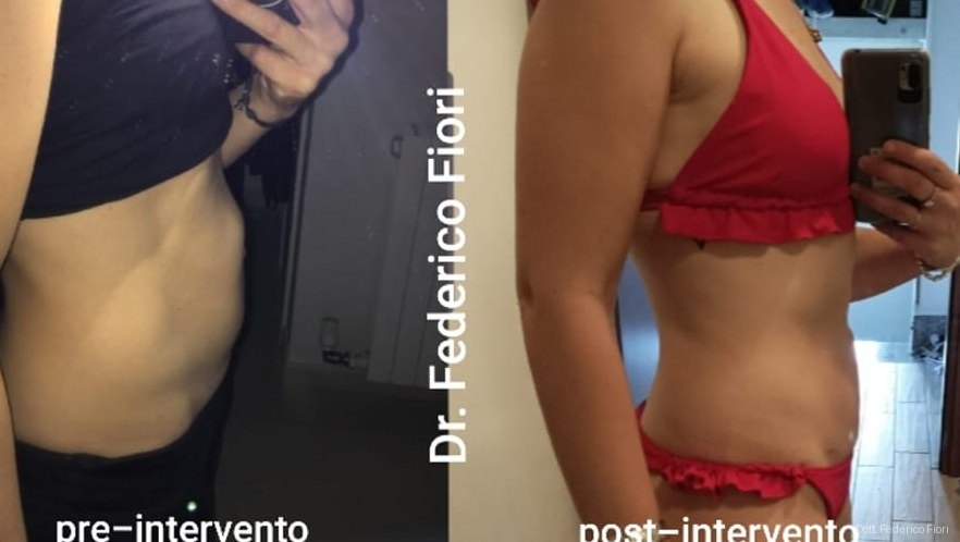Diastasi dei retti — Prima e dopo