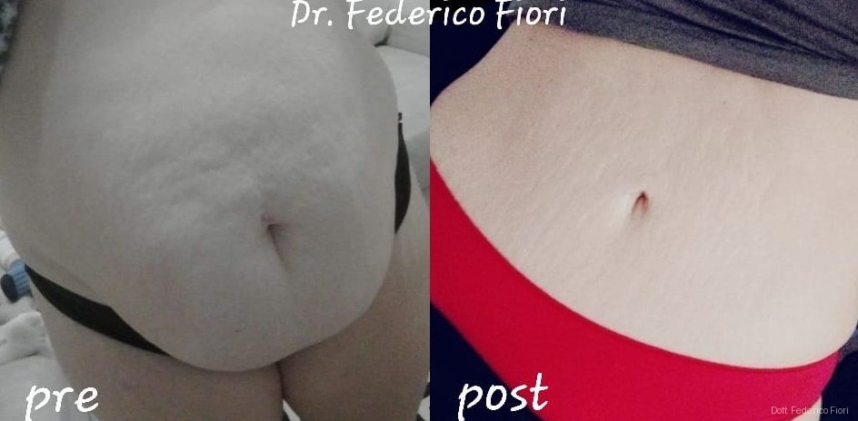 Diastasi dei retti — Prima e dopo