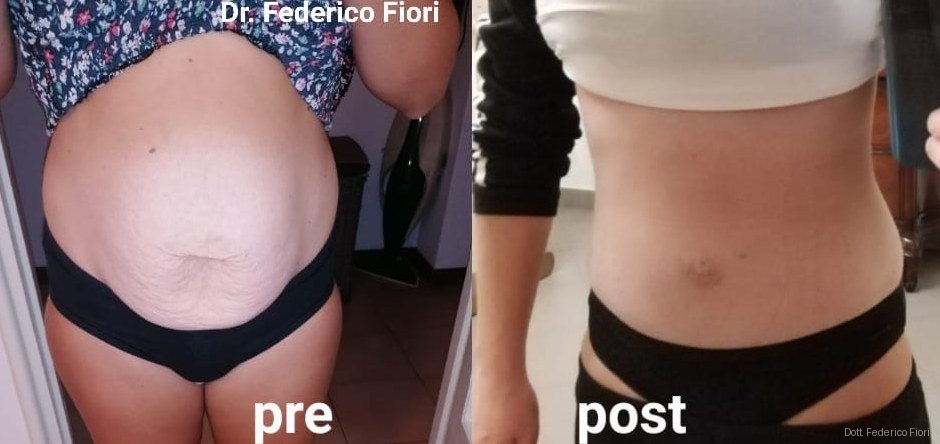 Diastasi dei retti — Prima e dopo