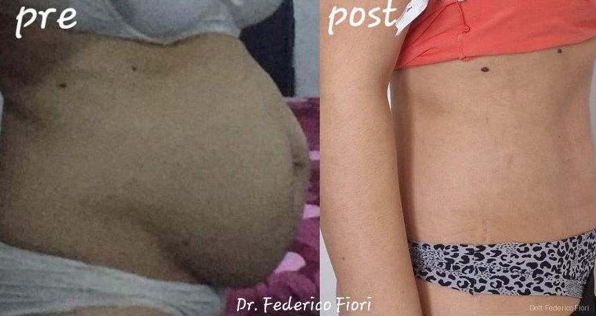 Diastasi dei retti — Prima e dopo