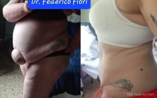 Diastasi dei retti — Prima e dopo
