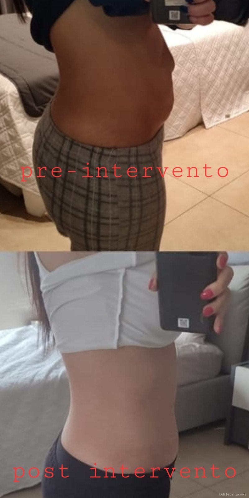 Diastasi dei retti — Prima e dopo