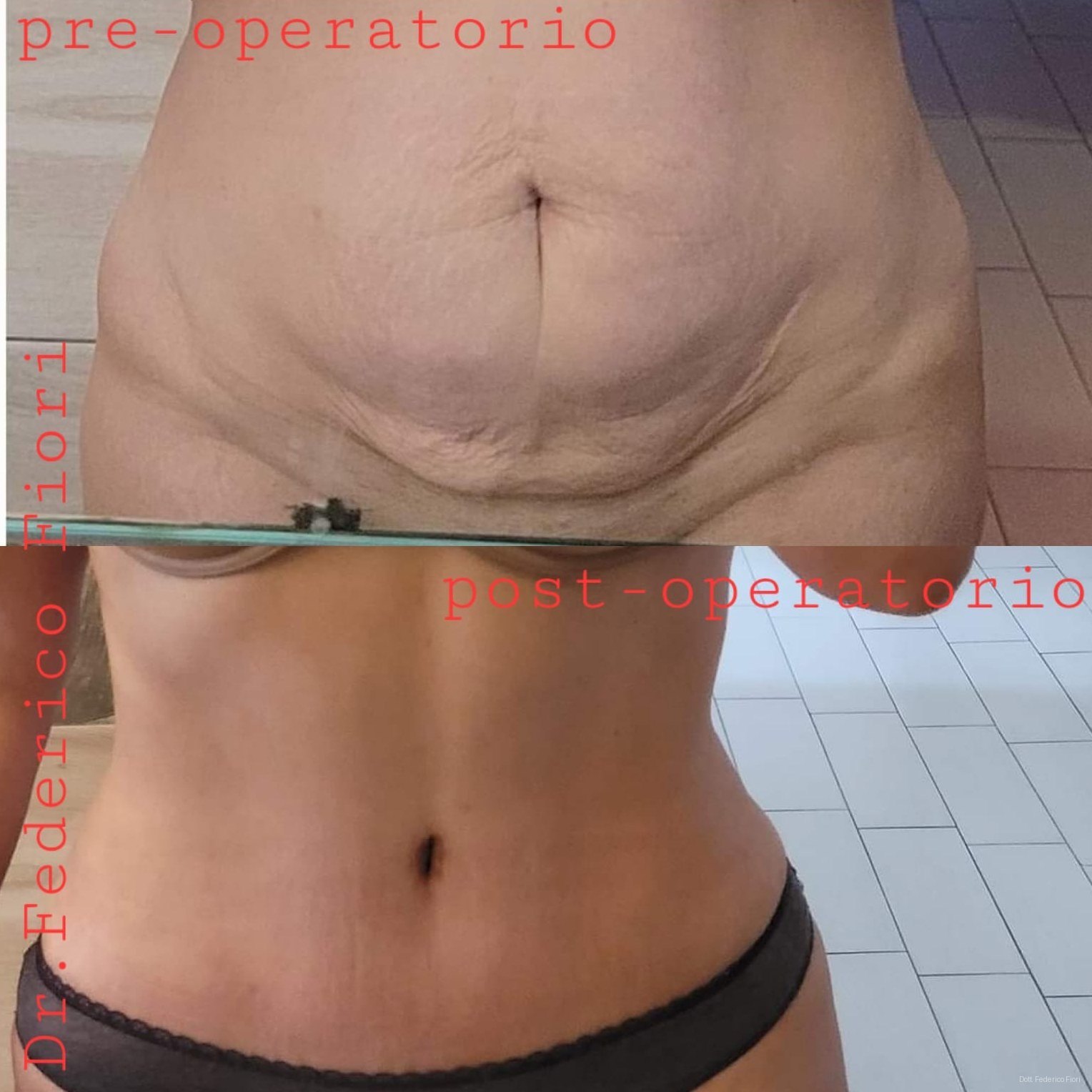 Diastasi dei retti — Prima e dopo