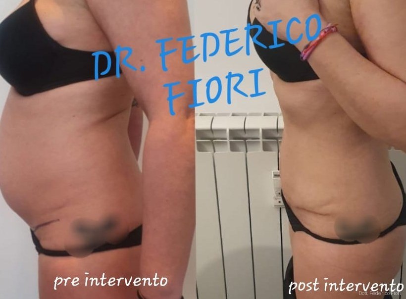 Diastasi dei retti — Prima e dopo