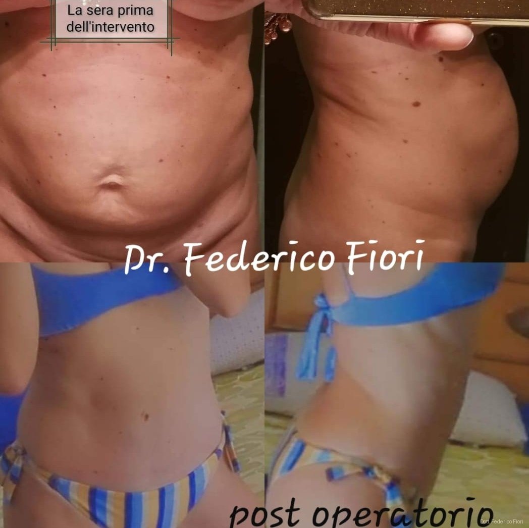 Diastasi dei retti — Prima e dopo