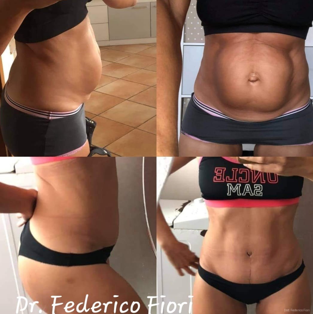 Diastasi dei retti — Prima e dopo